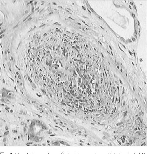 Figure 1 From A Case Of Renal Crisis In A Korean Scleroderma Patient