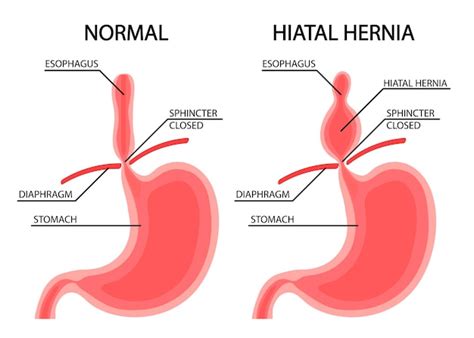 Free Vector | Man strangulated hernia diagram