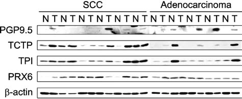 Immunoblot Analysis Of Differentially Secreted Proteins In Lung Cancer