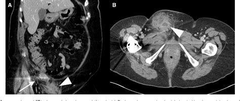 Figure 2 From Perforated Amyand Hernia With An Adenocarcinoma Tumour Presenting As A Groin