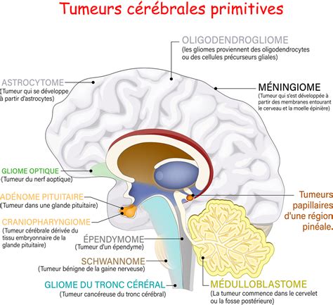 Les tumeurs au cerveau causes symptômes et traitements