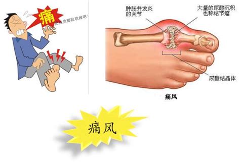 关注健康 远离痛风 北纬网（雅安新闻网）