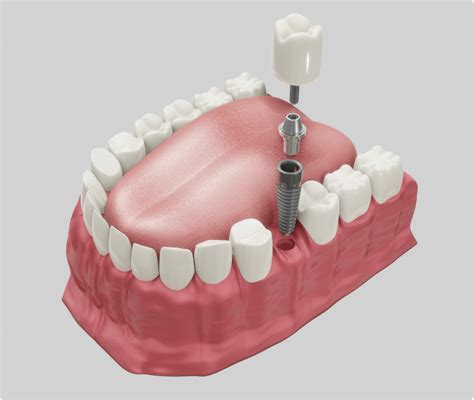 Front Tooth Implant Dental Implant Front Tooth In Brooklyn Ny