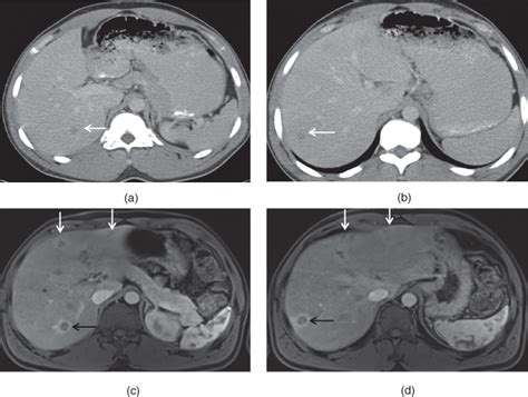 Liver Metastases CT Scan