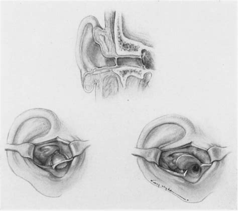 Figure 1 From Xci Lesions Of The External Auditory Canal Semantic Scholar