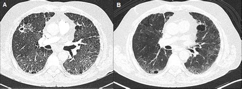 Long Term Response To PD 1 And CTLA 4 Blockade In An SCLC Patient With