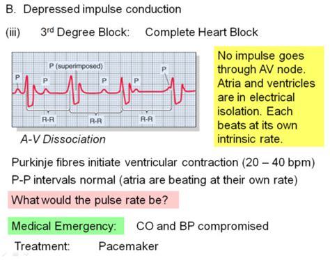 Heart Block Dysrhythmias Flashcards Quizlet