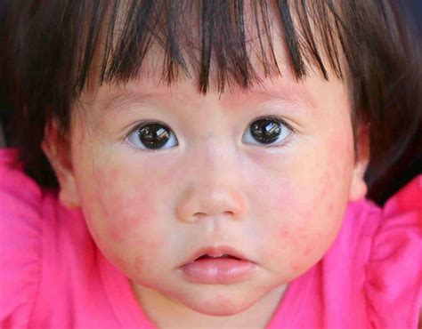 Alergia Do Calor Em Bebê Fotos - Alergia em bebe. Quais os tipos e como tratar. - Alergia Botafogo ...