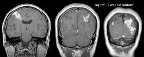 Subacute Infarction With Gyriform Enhancement Radiology Cases