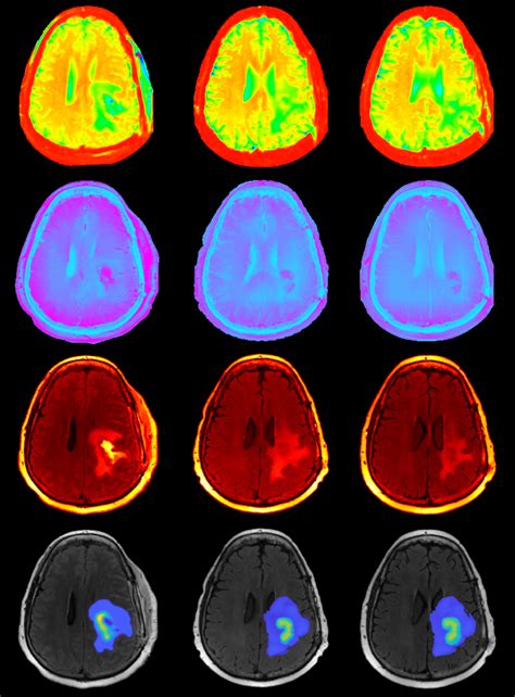 New Technique Predicts Response of Brain Tumors to Chemoradiation - UT News