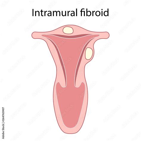 Intramural Fibroid Female Reproductive Organ Pathology Benign Tumor