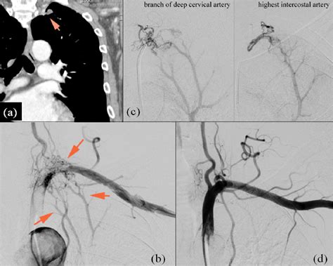 Figure From Transarterial Embolization Of Systemic Arteries For The