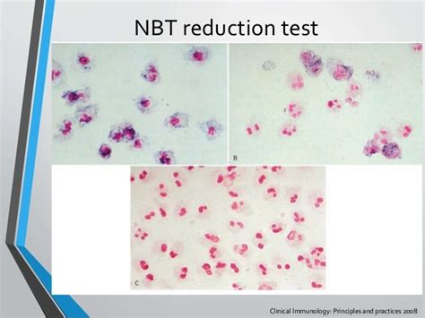 Chronic Granulomatous Disease