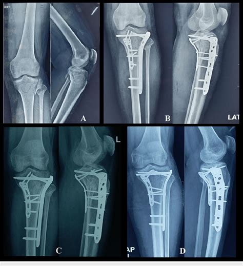 Serial Follow Up Radiographs Of A Year Old Male With Complex