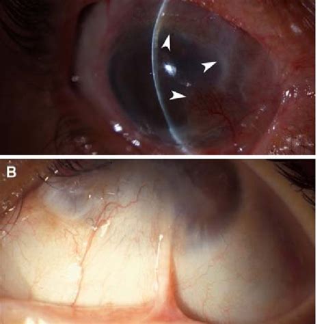 Stage Partial Limbal Stem Cell Deficiency A Conjunctival