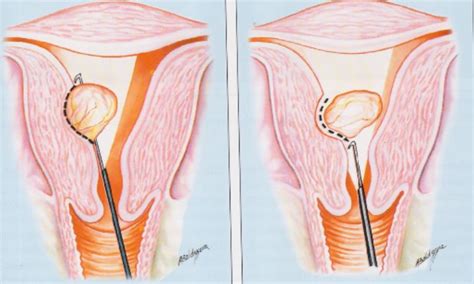 fibroids – Hysteroscopy Newsletter