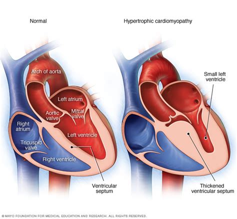 Hypertrophic Cardiomyopathy Hcom Hcm Stepwards