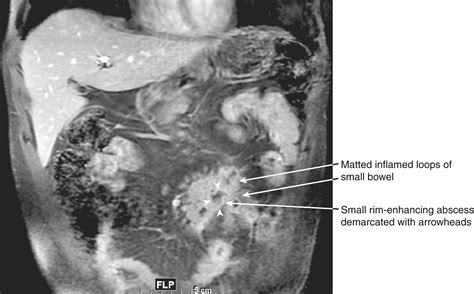 Abdominal Abscesses And Gastrointestinal Fistulas Clinical Tree