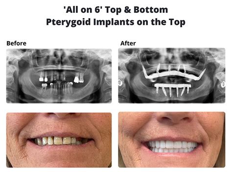 Zygomatic Pterygoid Implants Temecula Dental Implants Oral Surgery