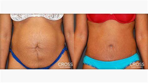 Full Tummy Tuck Belly Button Madnessinriko