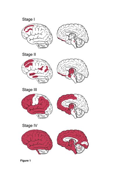 Chronic Traumatic Encephalopathy Stages