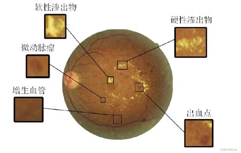 常用眼底图像数据集简介及下载 糖尿病视网膜病变 Eyepacsaptos2019stare数据集 灰信网（软件开发博客聚合）