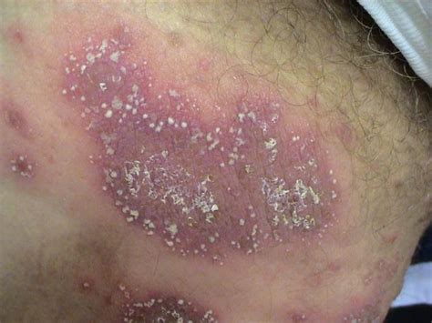 Psoriasis Pustular Psoriasis Picture Hellenic Dermatological Atlas