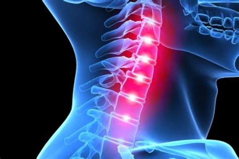 Common Questions About Recovery from Anterior Cervical Fusion Surgery ...