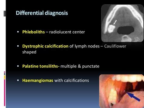 Sialolithiasis and its management in oral and maxillofacial surgery