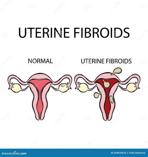 Uterine Fibroids Vs Normal Female Reproductive Education Set Stock