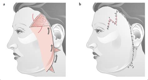 chin plastic surgery key