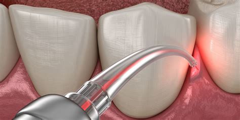 LANAP® Laser Gum Surgery - Miami, FL - Bleeding Gums