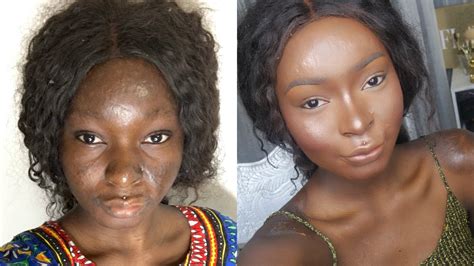 BURN SURVIVOR, SHALOM BLAC INSPIRING MAKEOVER STORY! SHE HAS THE MOST ...