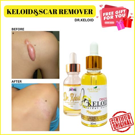 Healing Dr Keloid Keloid Remover Scar Removes Any Types Of Scar