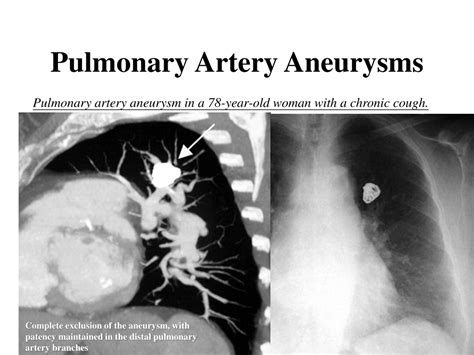 PPT Pulmonary Artery Interventions An Overview PowerPoint