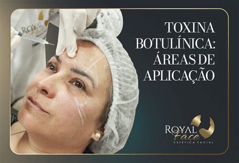 Botox no rosto: regiões de aplicação e efeitos