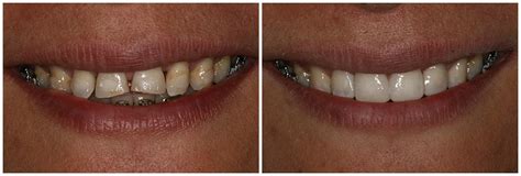 smile-gallery-before-and-after-slide-5 - Dawn A. Bova, DMD, MBA