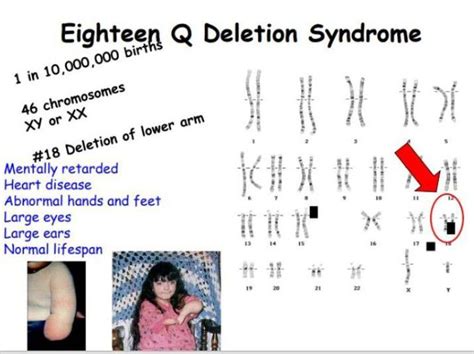 Eighteen Q Deletion Syndrome Medizzy