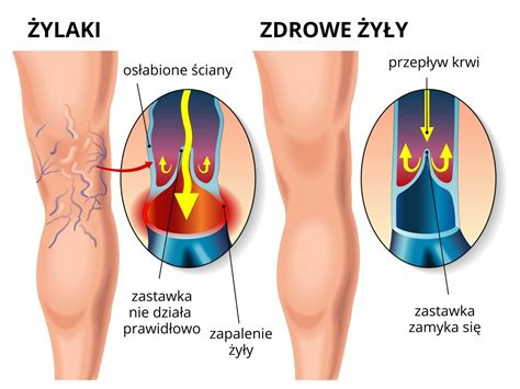 Przyczyny Objawy I Leczenie Ylak W Alfa