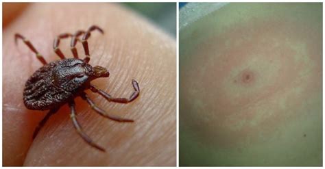 Tick Bites: How To Avoid These Irksome (And Dangerous) Little Parasites