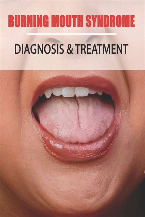 Burning Mouth Syndrome Diagnosis And Treatment Burning Mouth Syndrome Guide Paperback