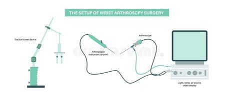 Wrist arthroscopy surgery stock illustration. Illustration of surgeon - 331026375