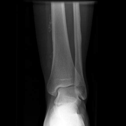 Phleboliths | Radiology Reference Article | Radiopaedia.org