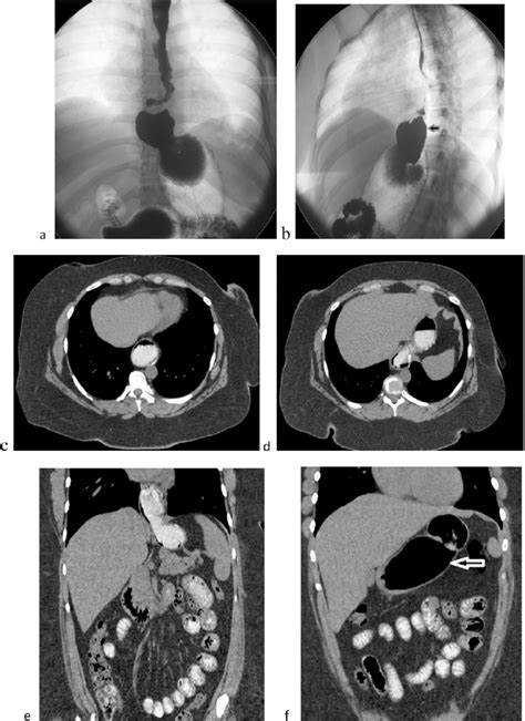 A Forty Year Old Female Patient With Bmi Of 56 Kg M 2 Weighted 165 Kg