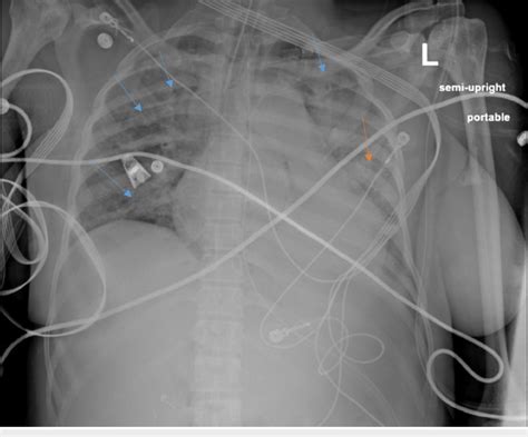 Patient S Chest X Ray After Transfer To The Icu Post Intubation New