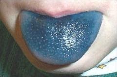 Doctors Gates: Blue Tongue Disease