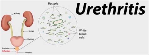 Urethritis Causes Symptoms And Treatment