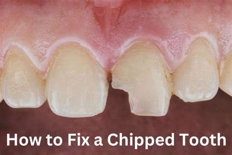 How To Fix A Chipped Tooth Diagnose Treatment And Look After