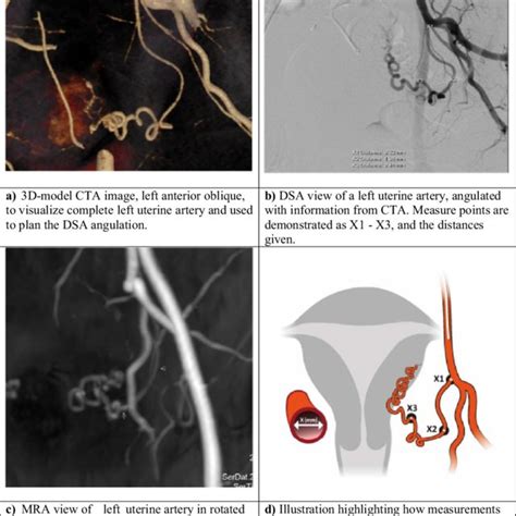 Pdf Imaging Evaluation Of Uterine Arteries In Potential Living Donors