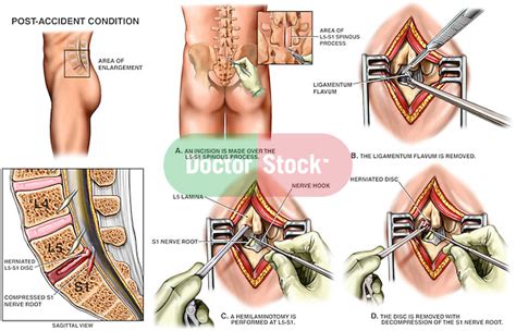 L5 S1 Hemilaminotomy And Microdiscectomy Doctor Stock